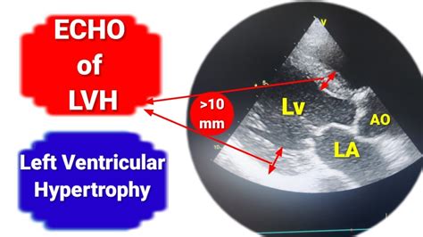 mild lvh on echo.